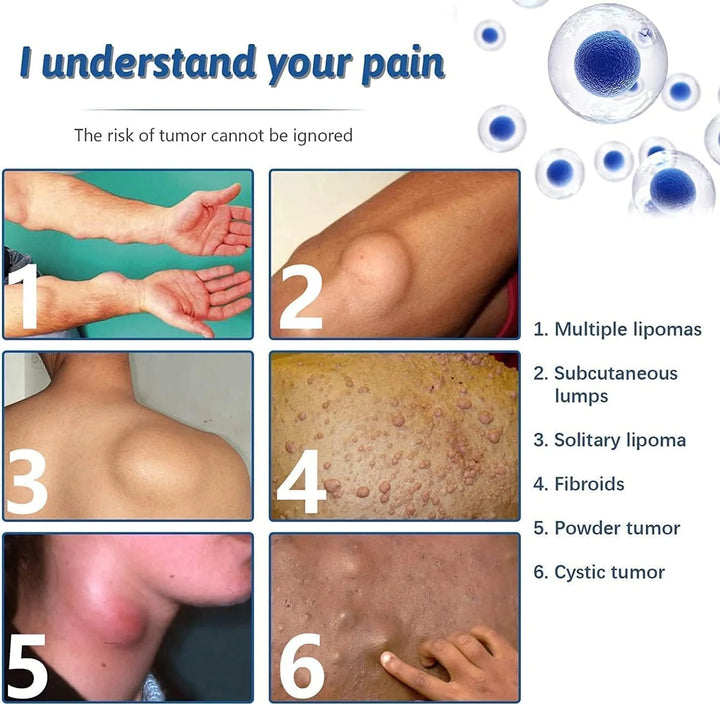 South Moon - Lipoma Removal Spray - HZ TANOLI LLC